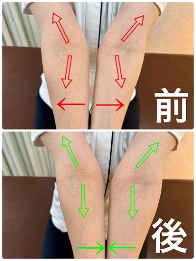腕　肘　不良姿勢の写真です